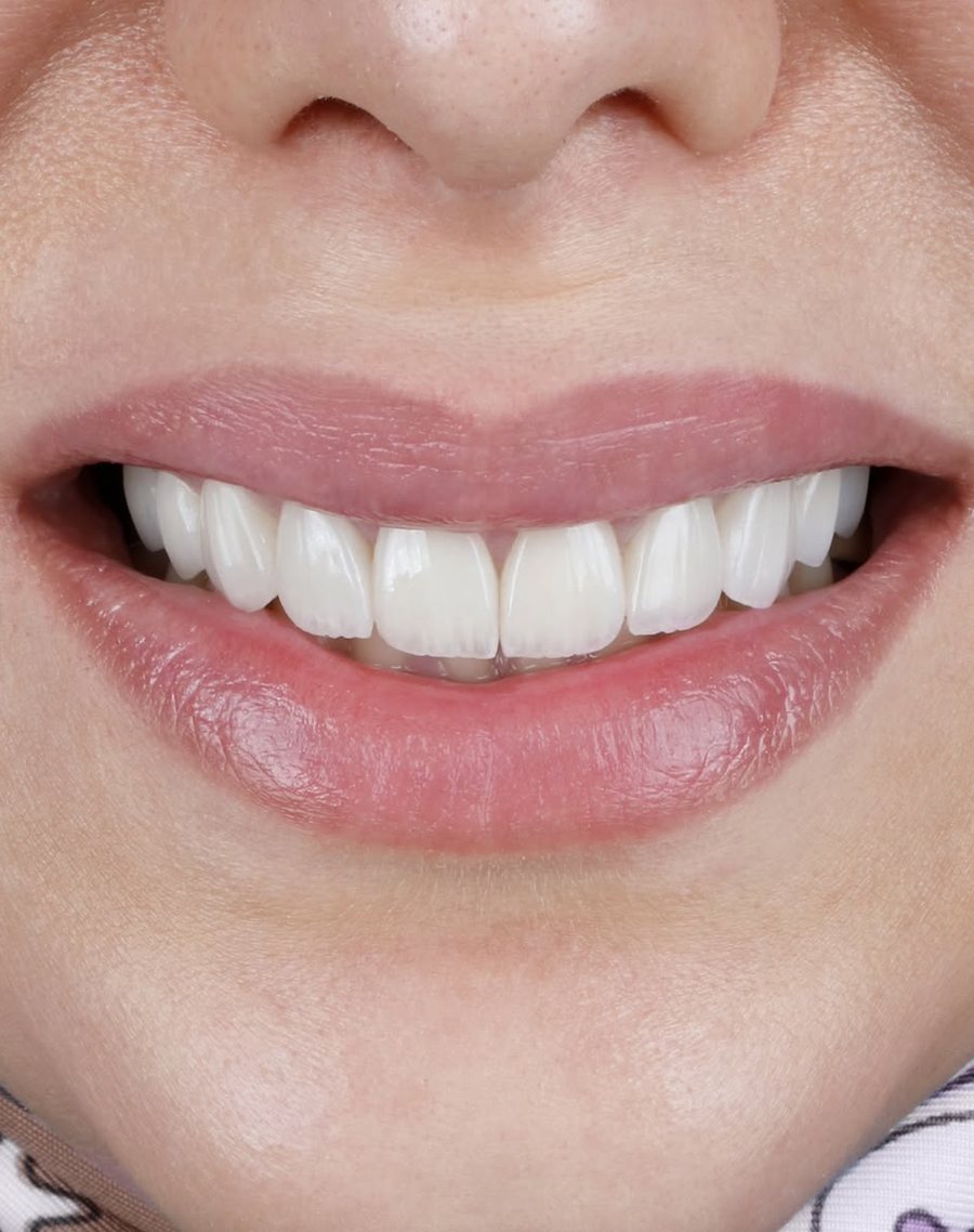 Dental Aesthetics & Tooth Reshaping